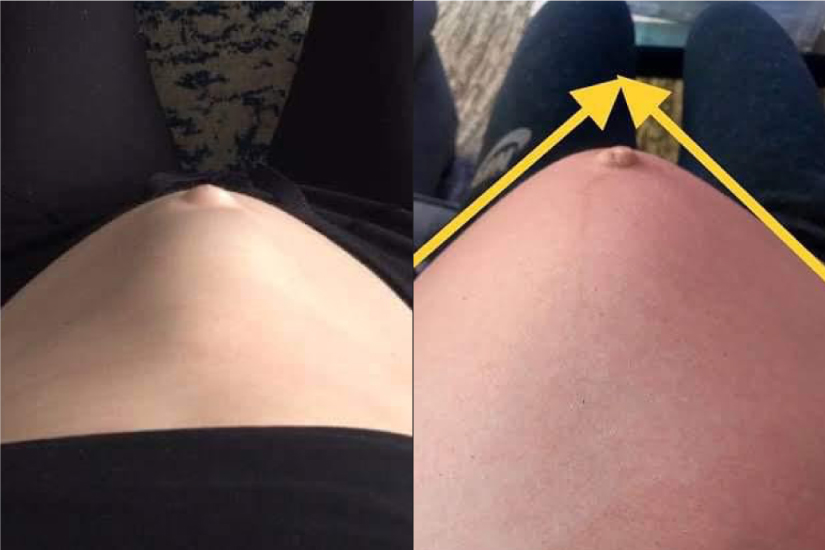 Image shows a dome down the middle of a tummy which is a way of identifying if one has diastasis recti.