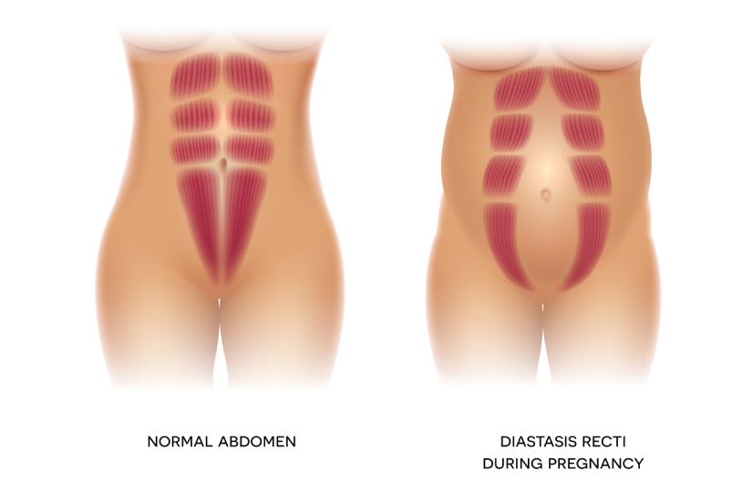 The image show how a normal abdomen looks versus how an abdomen with diastasis recti looks